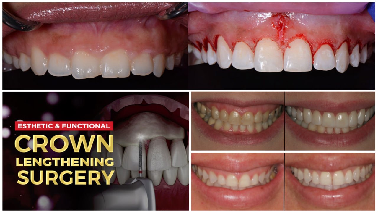 Esthetic and functional crown lengthening surgery
