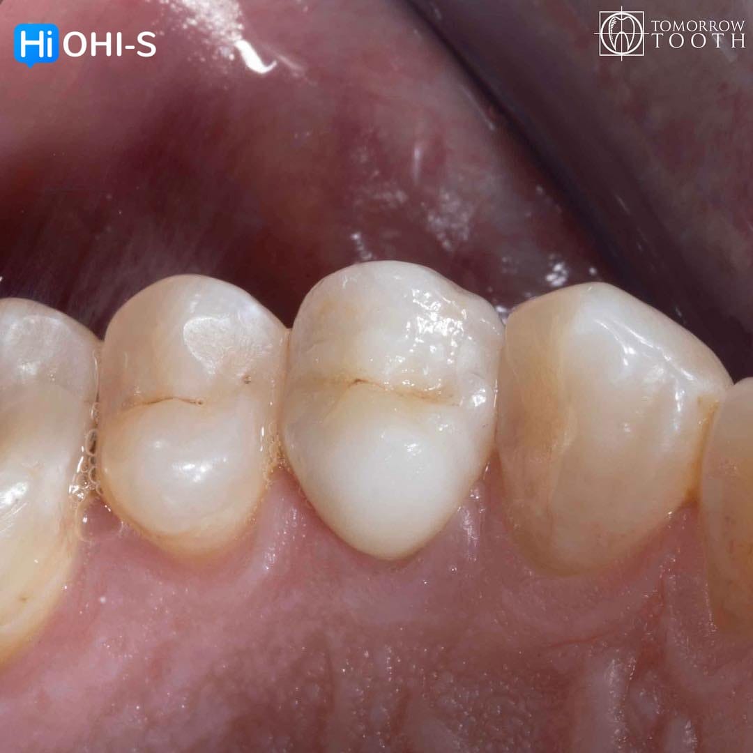 Vertical Preparation Protocols The Complete Guide in 24 Lessons from Tomorrow Tooth