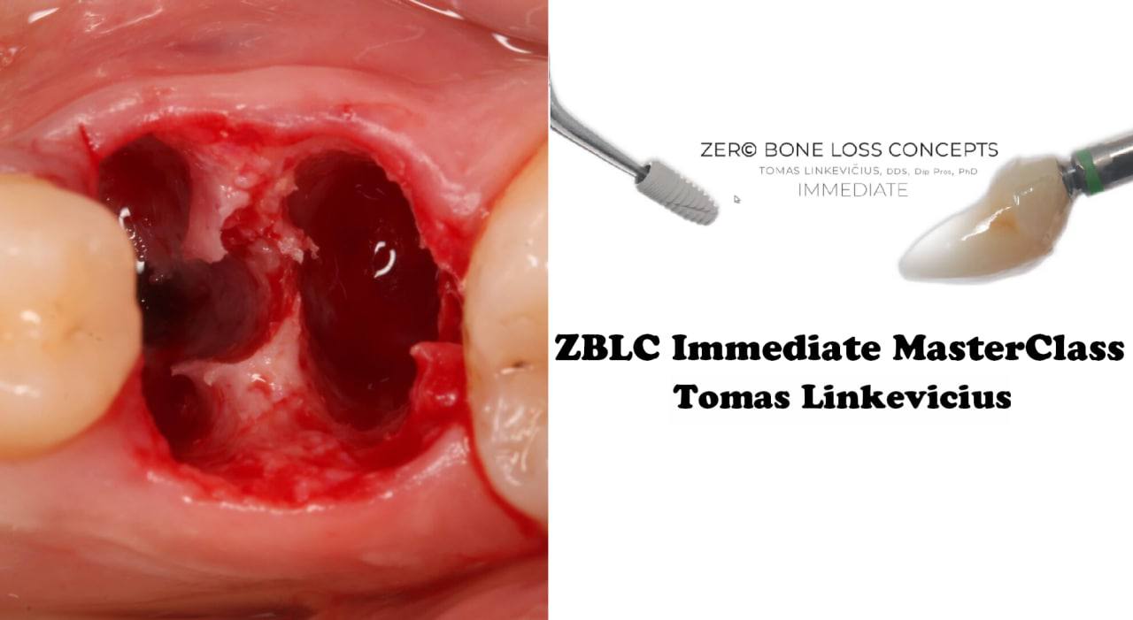 Zero Bone Loss Concepts, Immediate implants