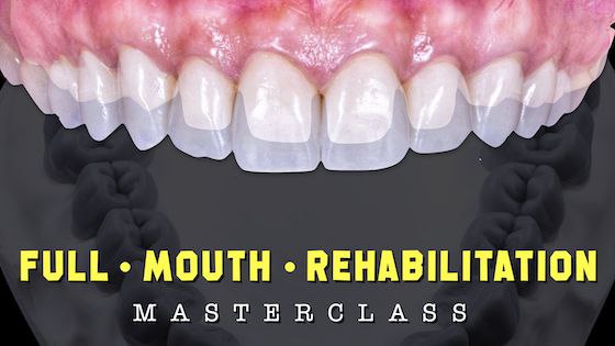 full mouth reconstruction Dr. Moez Khakiani (New online version with 2024 updates)
