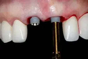 Online Residency Program A-Z in Implant Dentistry | Comprehensive Masterclass