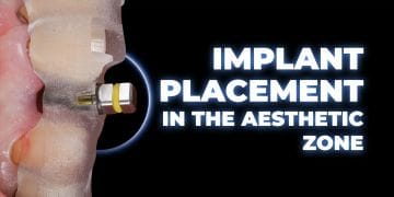 Implant placement in the aesthetic zone: steps and techniques