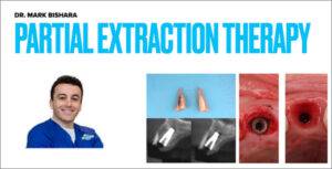 Partial Extraction Therapy (PET) & Socket Shield Technique