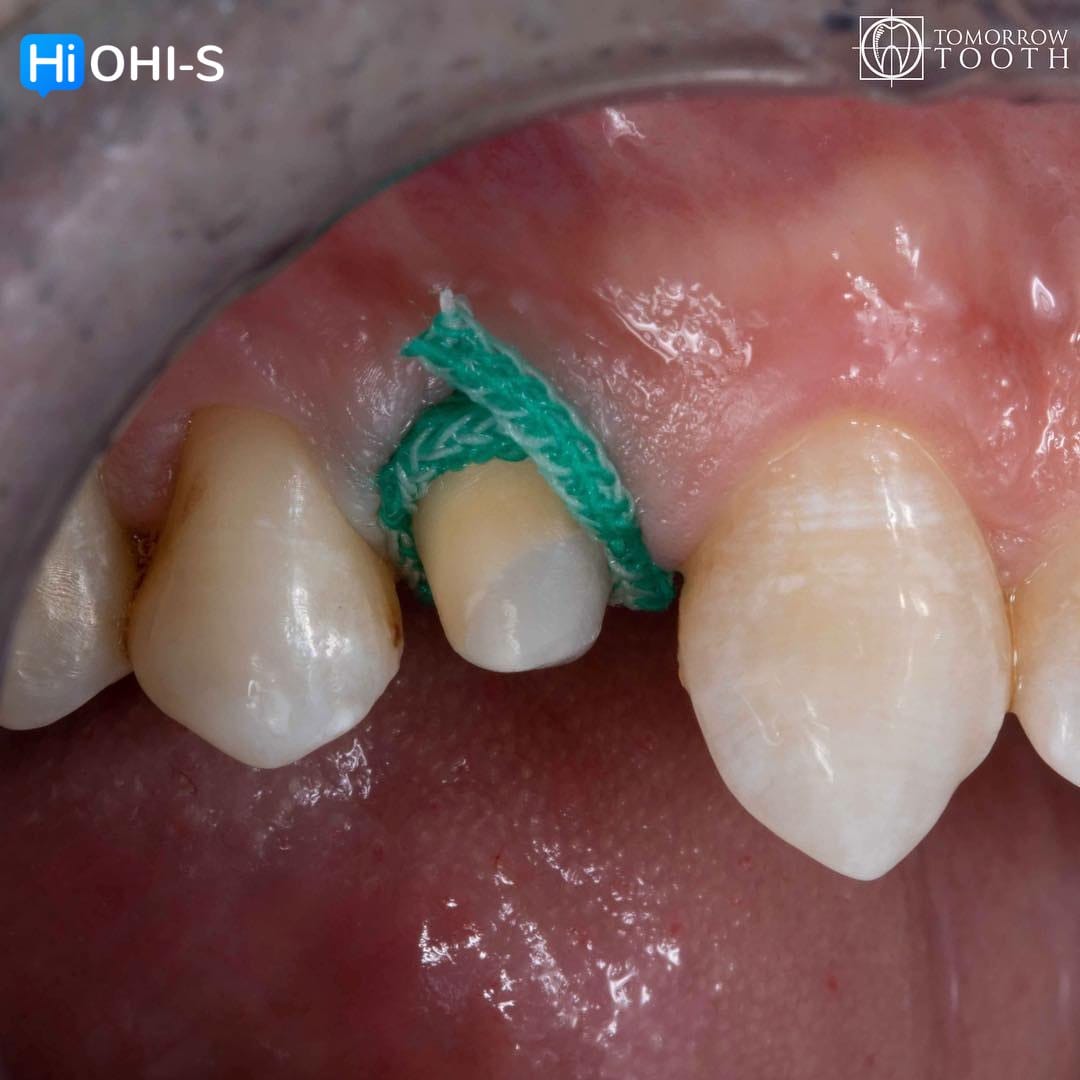 Vertical Preparation Protocols The Complete Guide in 24 Lessons from Tomorrow Tooth