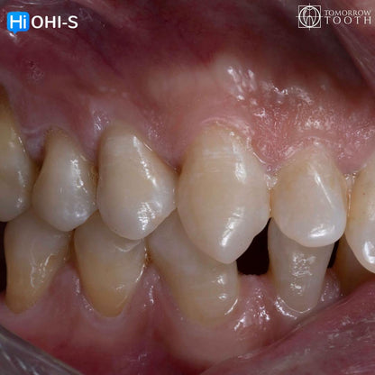 Vertical Preparation Protocols The Complete Guide in 24 Lessons from Tomorrow Tooth