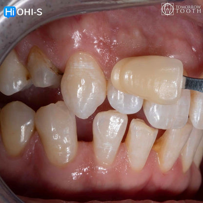 Vertical Preparation Protocols The Complete Guide in 24 Lessons from Tomorrow Tooth