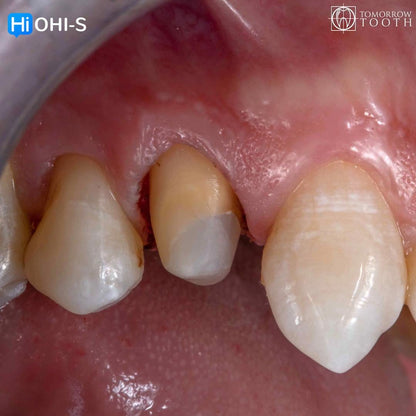 Vertical Preparation Protocols The Complete Guide in 24 Lessons from Tomorrow Tooth