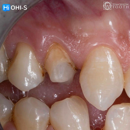 Vertical Preparation Protocols The Complete Guide in 24 Lessons from Tomorrow Tooth