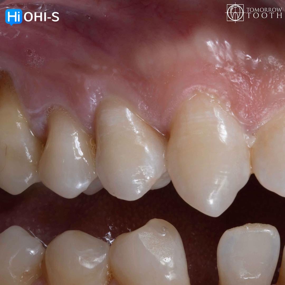 Vertical Preparation Protocols The Complete Guide in 24 Lessons from Tomorrow Tooth